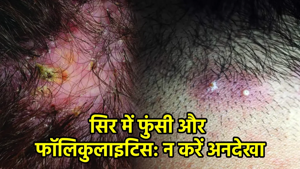 सिर में फुंसी और फॉलिकुलाइटिस: न करें अनदेखा